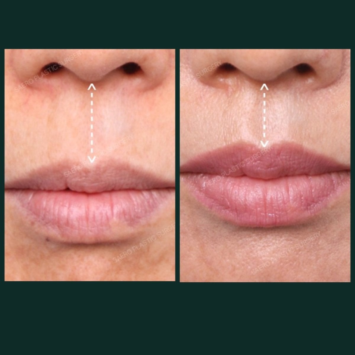Resultados de lifting de labios antes y después en SAERO Plastic Surgery – contorno mejorado