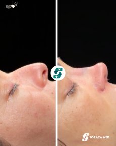 before-after photo rhinoplasty-nose-job