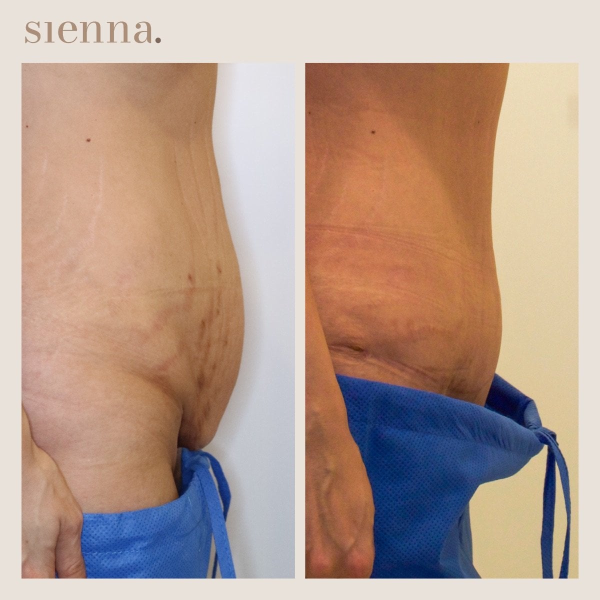 نتائج شفط دهون البطن قبل وبعد في Sienna Clinic – خصر أنحف