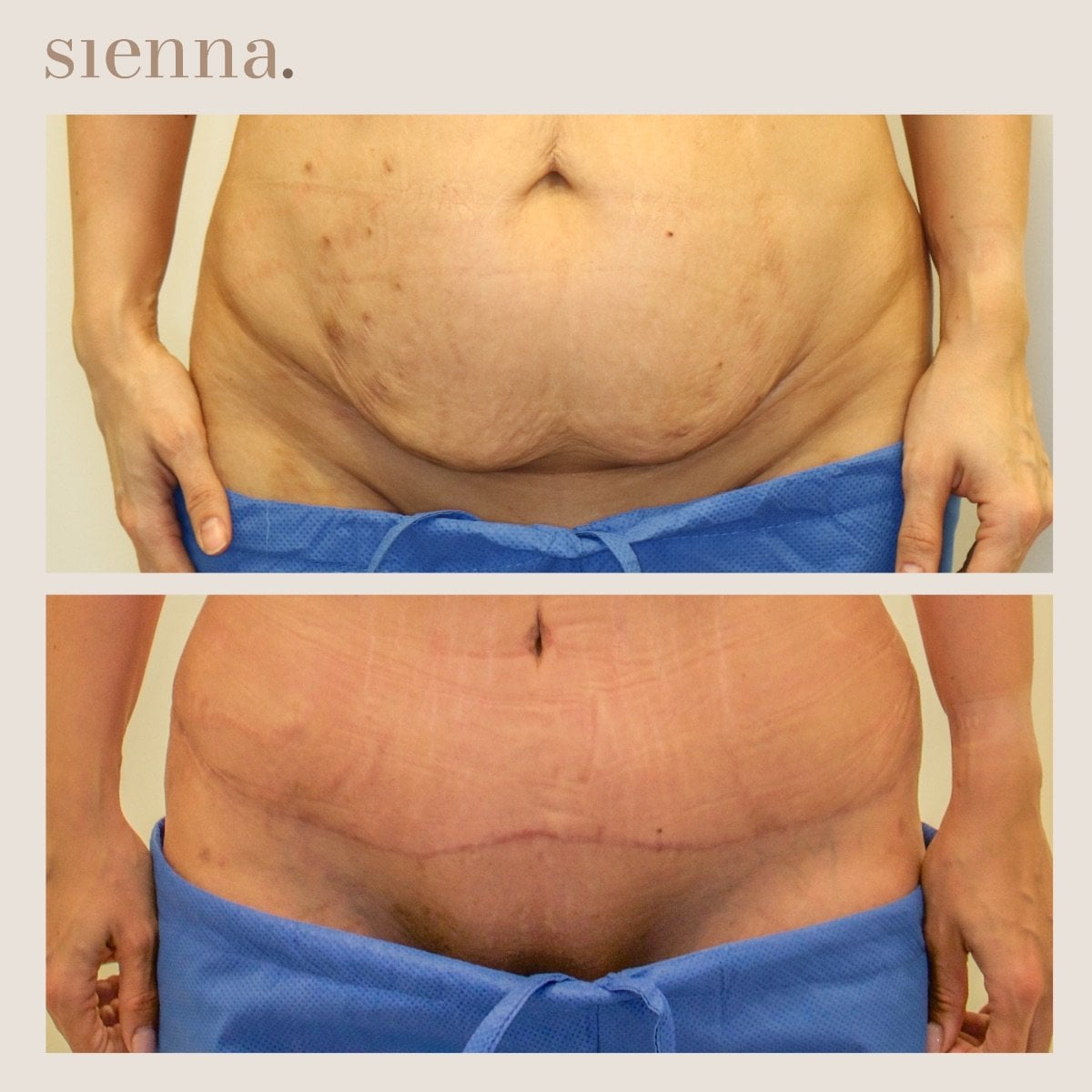 نتائج شفط دهون البطن قبل وبعد في Sienna Clinic – تحسين شكل الجسم