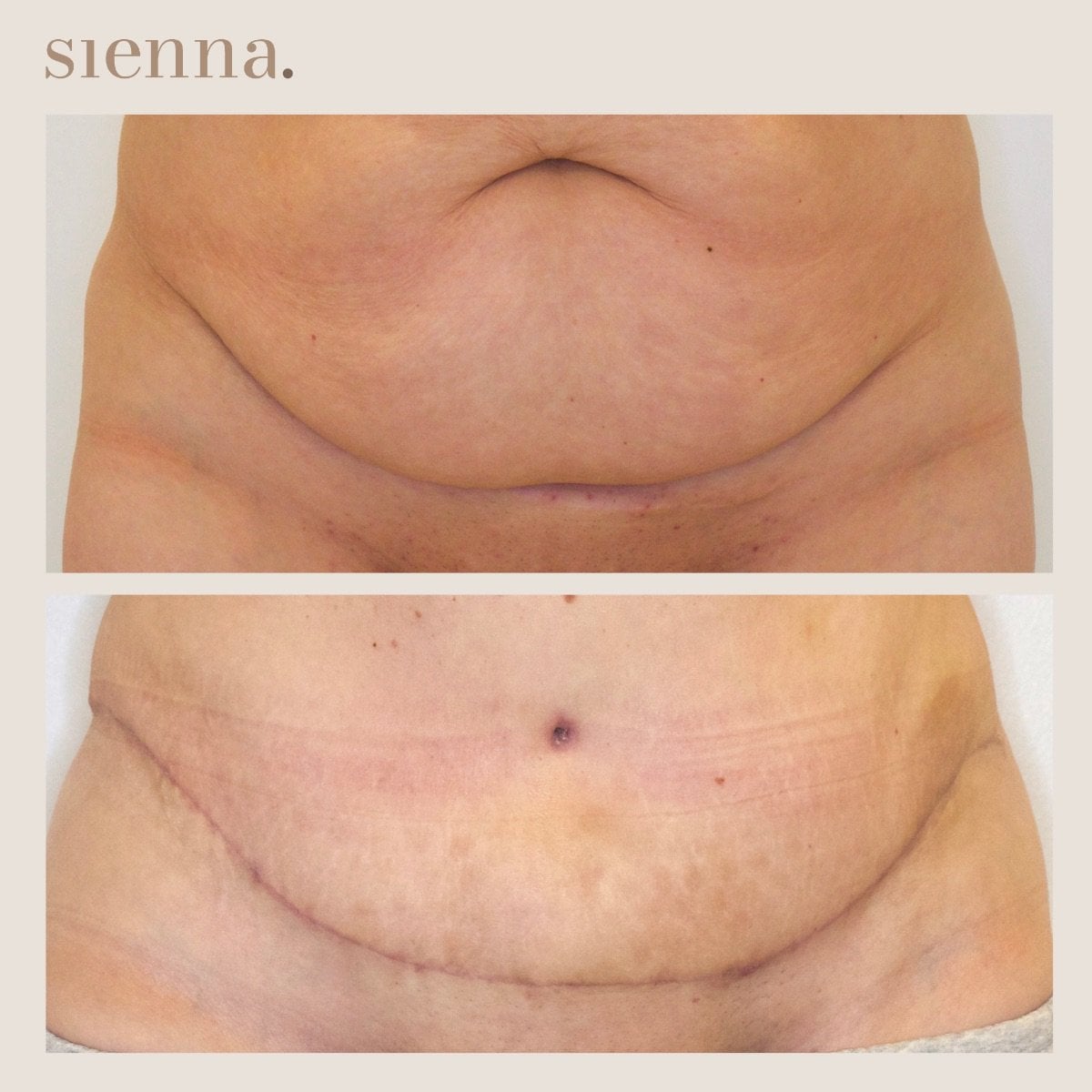 نتائج شفط دهون البطن قبل وبعد في Sienna Clinic، تحسين واضح لشكل البطن