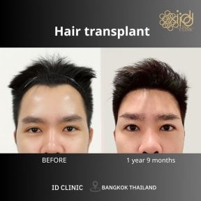 before-after photo hair-transplant