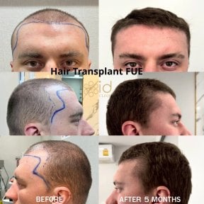 before-after photo hair-transplant