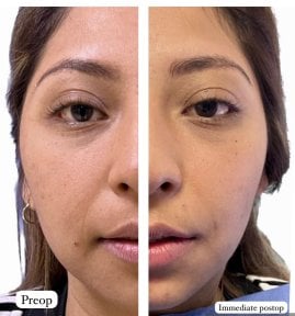 before-after photo buccal-fat-extraction