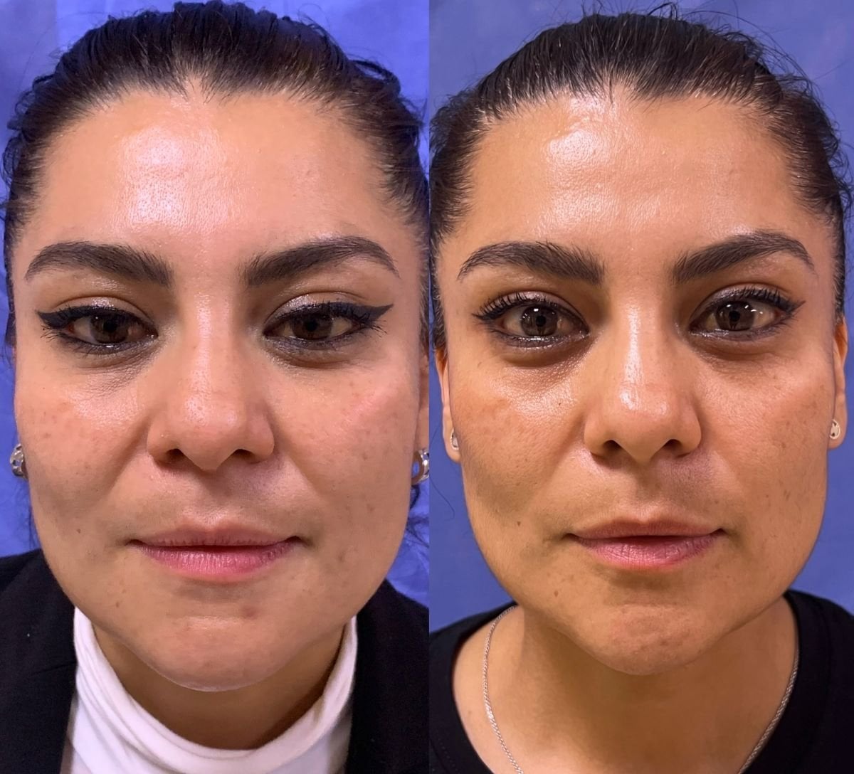 Before and after buccal fat extraction at Lucio Santos Plastic Surgery, slimmer face result