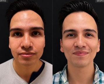 before-after photo buccal-fat-extraction