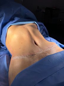 before-after photo abdominoplastika