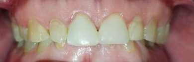 before-after photo dental-implant
