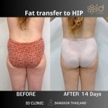 Результат ліпофілінгу стегон в ID Clinic Bangkok, помітне покращення контуру стегон