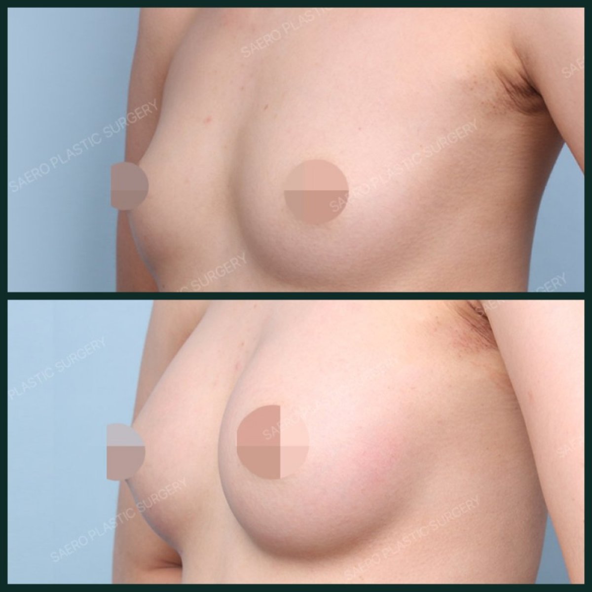 قبل وبعد تكبير الثدي في SAERO Plastic Surgery، زيادة واضحة في الحجم