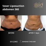 Результати до і після Vaser ліпосакції живота 360 в ID Clinic Bangkok, струнка талія