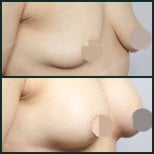 Vorher-nachher-Ergebnisse Brustvergrößerung bei SAERO Plastic Surgery, mehr Brustvolumen