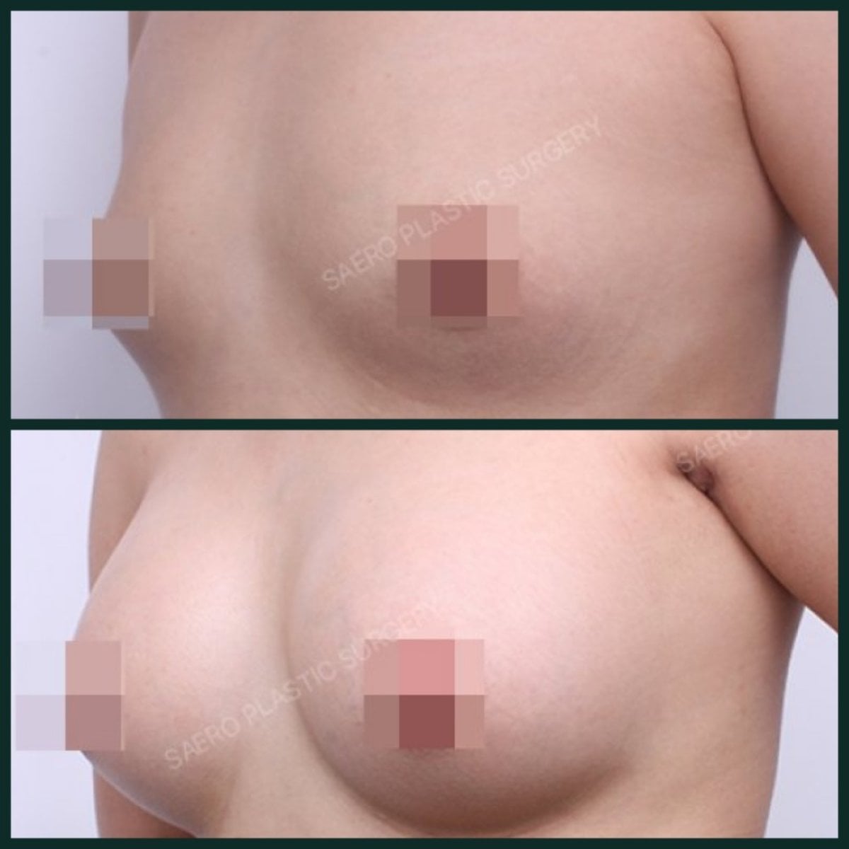 Resultados antes y después de aumento de senos en SAERO Plastic Surgery, mayor volumen mamario