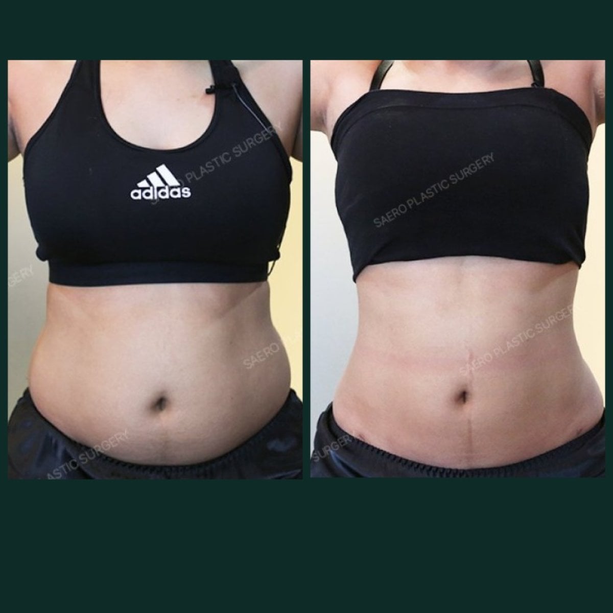 Resultados de abdominoplastia antes y después en SAERO Plastic Surgery – abdomen plano