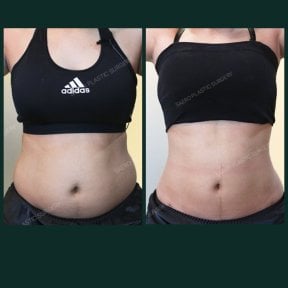 Before and after tummy tuck results at SAERO Plastic Surgery – flatter, contoured abdomen