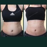 Before and after tummy tuck results at SAERO Plastic Surgery – flatter, contoured abdomen