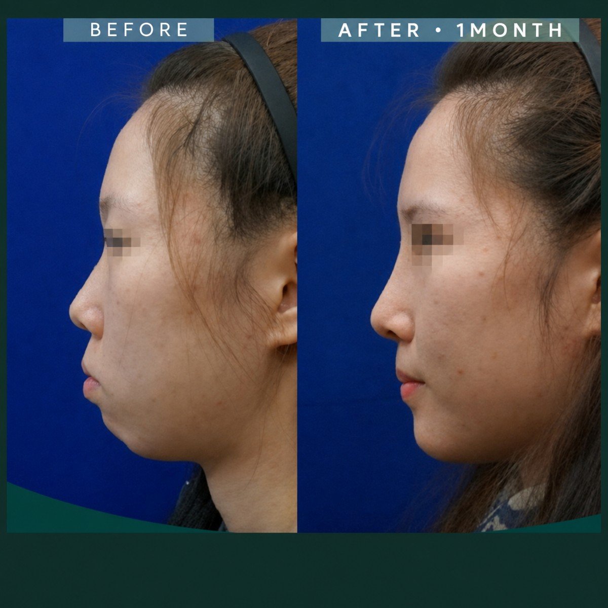 Resultados antes y después de reducción de pómulos en SAERO Plastic Surgery, contorno mejorado