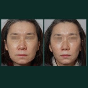 Before and after jawline contouring results at SAERO Plastic Surgery, improved facial definition