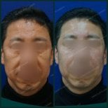 Jawline contouring before and after results at SAERO Plastic Surgery, improved facial definition