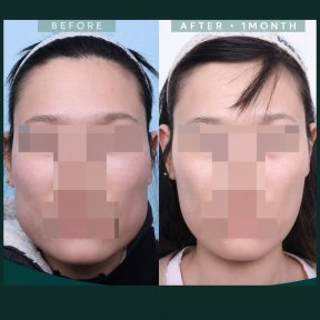 Résultats lifting du front avant/après chez SAERO Plastic Surgery, sourcils relevés après 1 mois