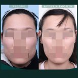 Résultats lifting du front avant/après chez SAERO Plastic Surgery, sourcils relevés après 1 mois