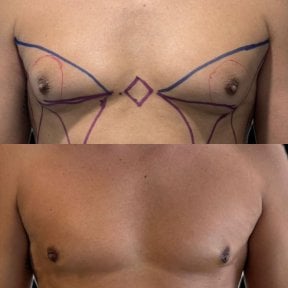 Before and after gynecomastia surgery result at Lucio Santos Plastic Surgery, male chest contour