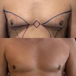 Before and after gynecomastia surgery result at Lucio Santos Plastic Surgery, male chest contour