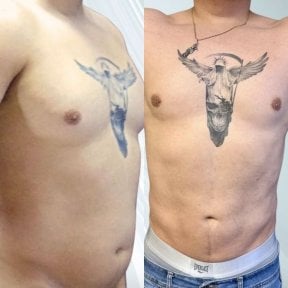 Before and after gynecomastia surgery results at Lucio Santos Plastic Surgery, flatter chest