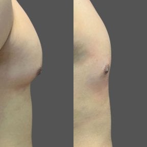Before and after gynecomastia surgery results at Lucio Santos Plastic Surgery, chest contouring