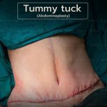 Abdominoplasty (tummy tuck) result at Intrarat Hospital – visible post-surgery improvement