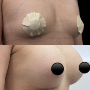 Before and after breast augmentation at Lucio Santos Plastic Surgery, enhanced breast volume result