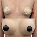 Before and after breast augmentation at Lucio Santos Plastic Surgery, enhanced breast volume result