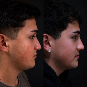 Before and after rhinoplasty result at Lucio Santos Plastic Surgery, improved nose profile