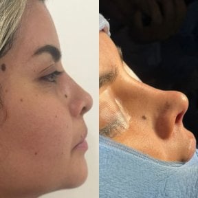 Before and after rhinoplasty result at Lucio Santos Plastic Surgery, nose reshaping outcome