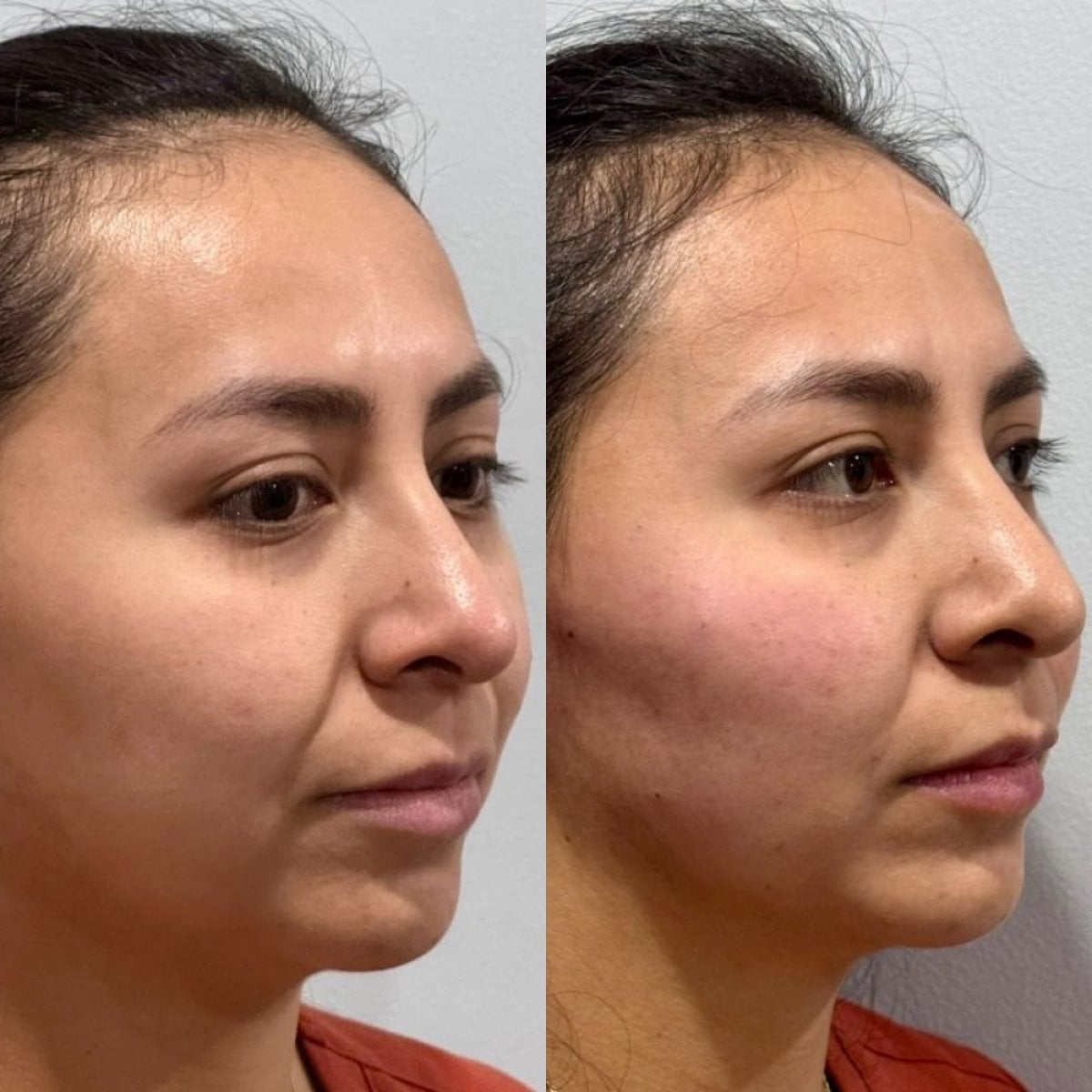 Before and after buccal fat extraction at Lucio Santos Plastic Surgery, slimmer cheek result