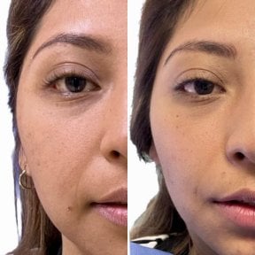 Before and after buccal fat extraction at Lucio Santos Plastic Surgery, slimmer cheek results