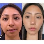 Before and after buccal fat extraction at Lucio Santos Plastic Surgery, facial contour results