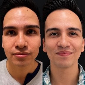 Before and after buccal fat extraction at Lucio Santos Plastic Surgery, slimmer facial contour result
