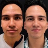 Before and after buccal fat extraction at Lucio Santos Plastic Surgery, slimmer facial contour result