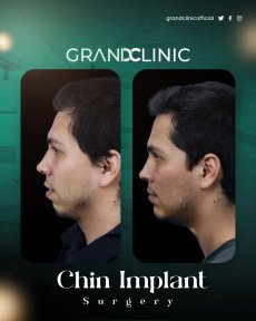 Résultats avant et après implant du menton à Grand Clinic, profil du menton amélioré