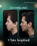 Résultats avant et après implant du menton à Grand Clinic, profil du menton amélioré