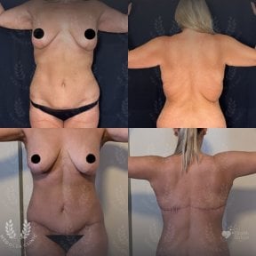 Результаты до и после mommy makeover в клинике Dr. Safa Manav, улучшение контуров тела
