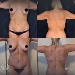 Результаты до и после mommy makeover в клинике Dr. Safa Manav, улучшение контуров тела