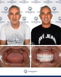 نتائج زراعة الأسنان قبل وبعد في Inter Dental Turkey – استعادة كاملة للابتسامة