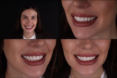 before-after photo installation-of-a-veneer