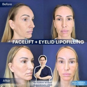 before-after photo tightening-of-facial-skin-facelift