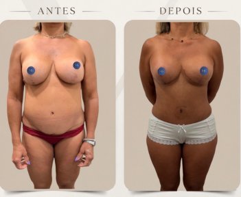 before-after photo mommy-makeover