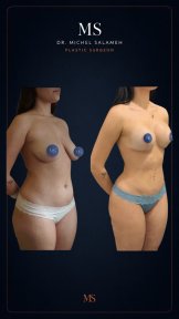 before-after photo liposculpture