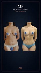 before-after photo liposculpture