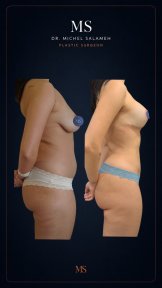 before-after photo liposculpture